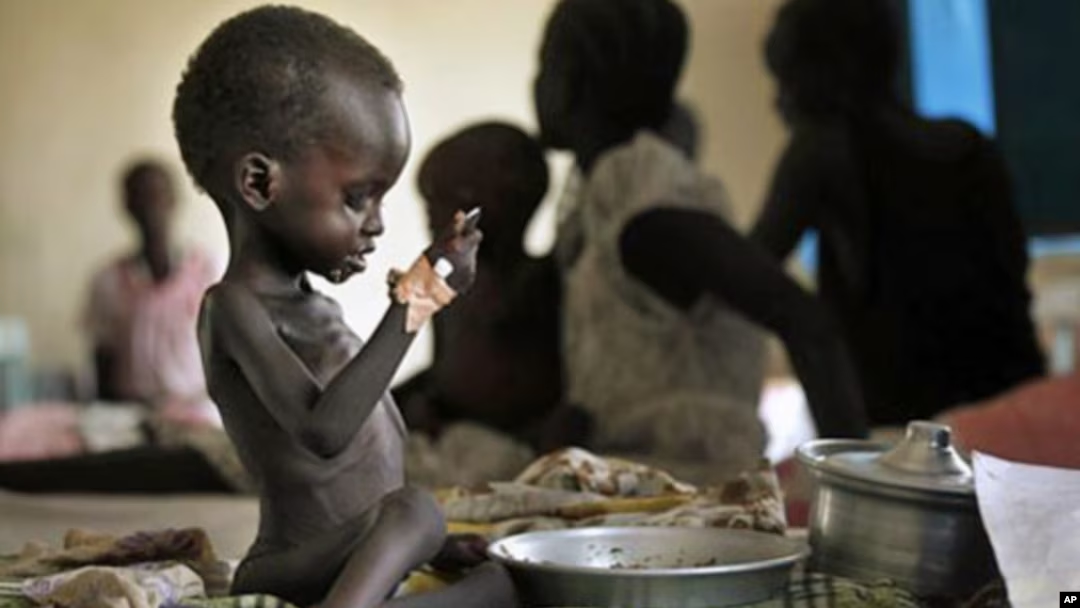 Malnourished child in need of aid